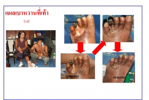 การรักษาแผลเบาหวาน