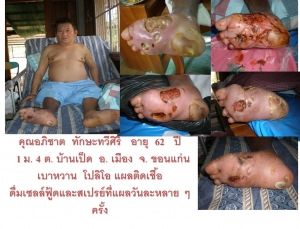 รักษาแผลเบาหวาน