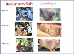 เบาหวาน