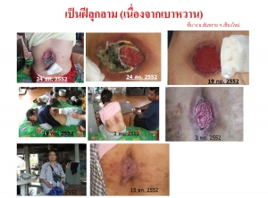 แผลเบาหวาน