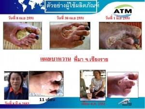 โรคเบาหวาน