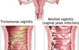 อาการคันในช่องคลอด